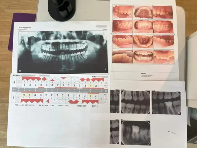 歯周病治療のレントゲン撮影